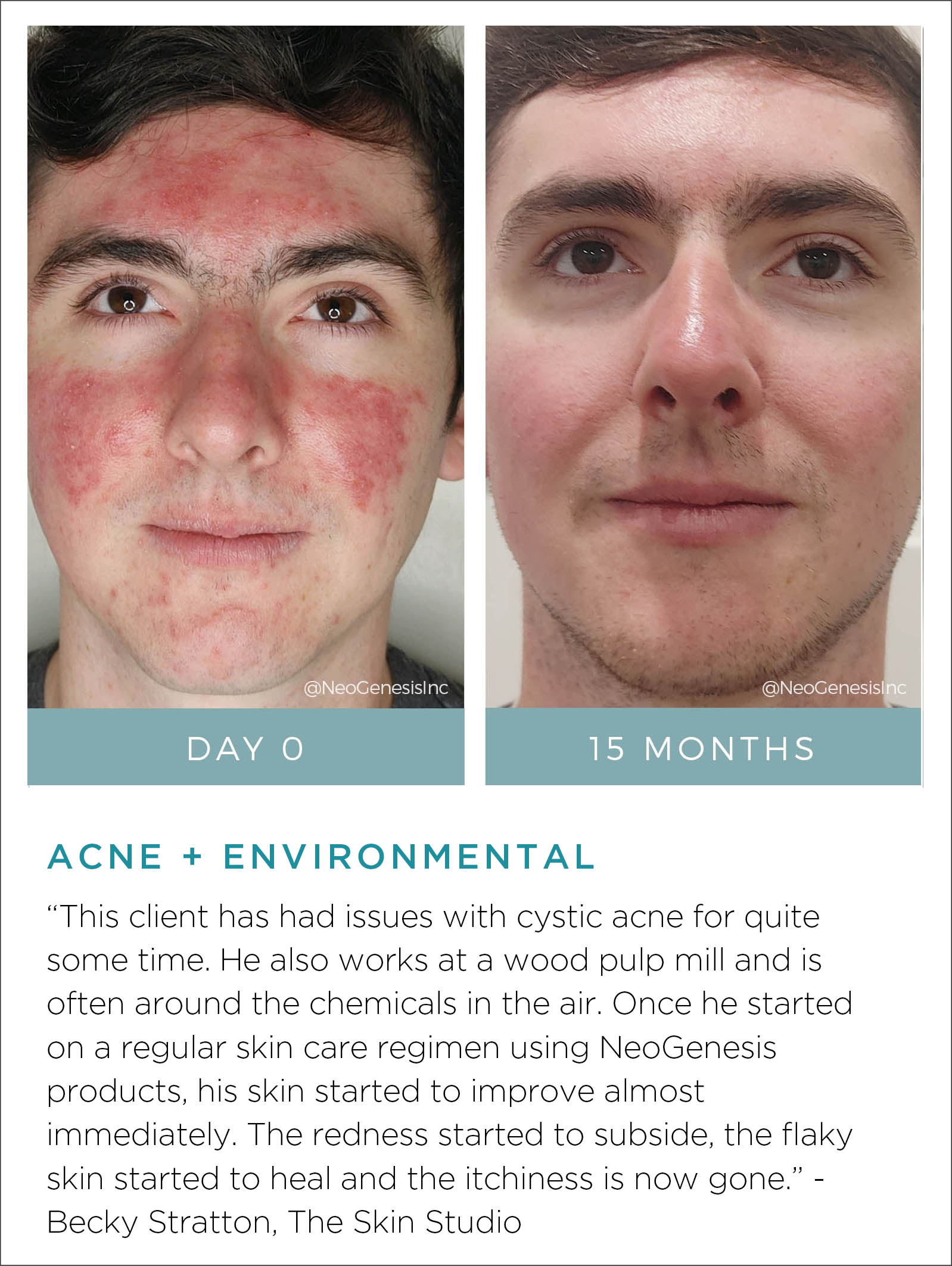 Oily + Problem Skin - Acne + Environmental Before + After