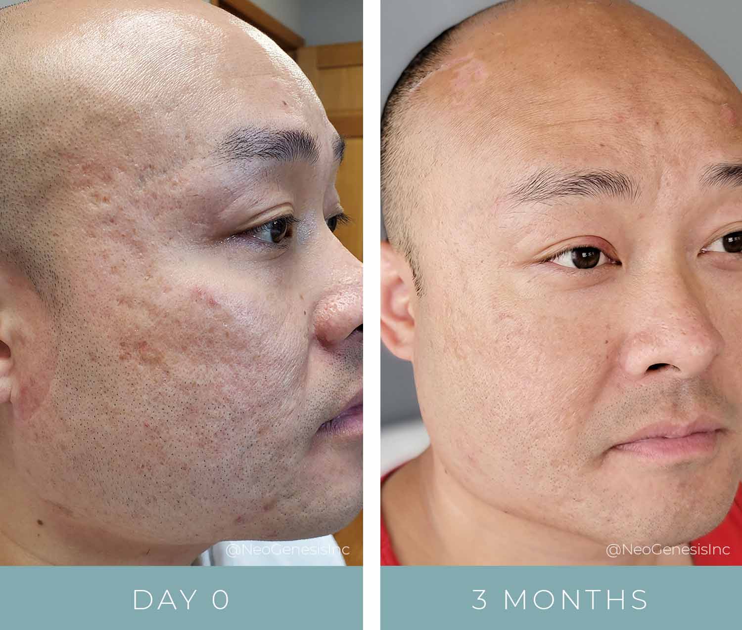 Before + After - Acne + Acne Scarring
