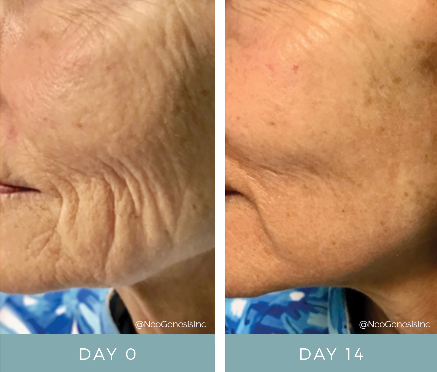 Before + After - Mature + Aging Skin - Fibroblast and NeoGenesis Skin Care Products