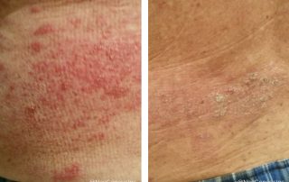 Shingles - Before + After