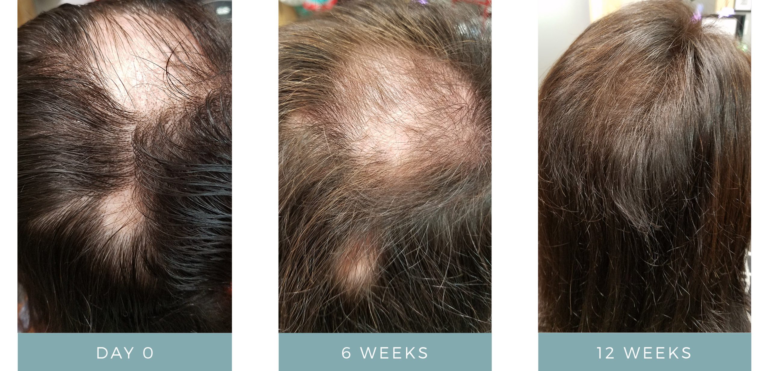 Before + After - Alopecia Arietta - Hair Loss