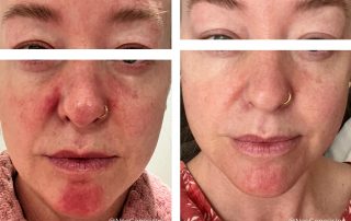Before + After - Perioral Dermatitis