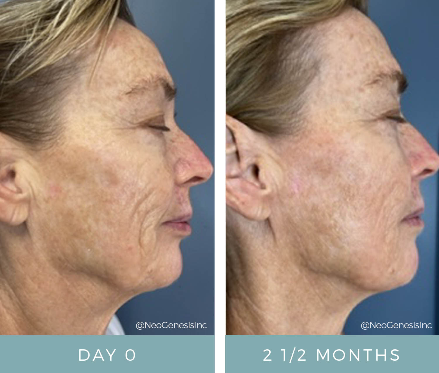 Before + After - Aging Skin + PIH + Melasma + Sun Damage + Skin Cancer